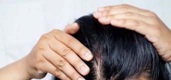 Jak zahamować proces łysienia naturalnymi metodami?